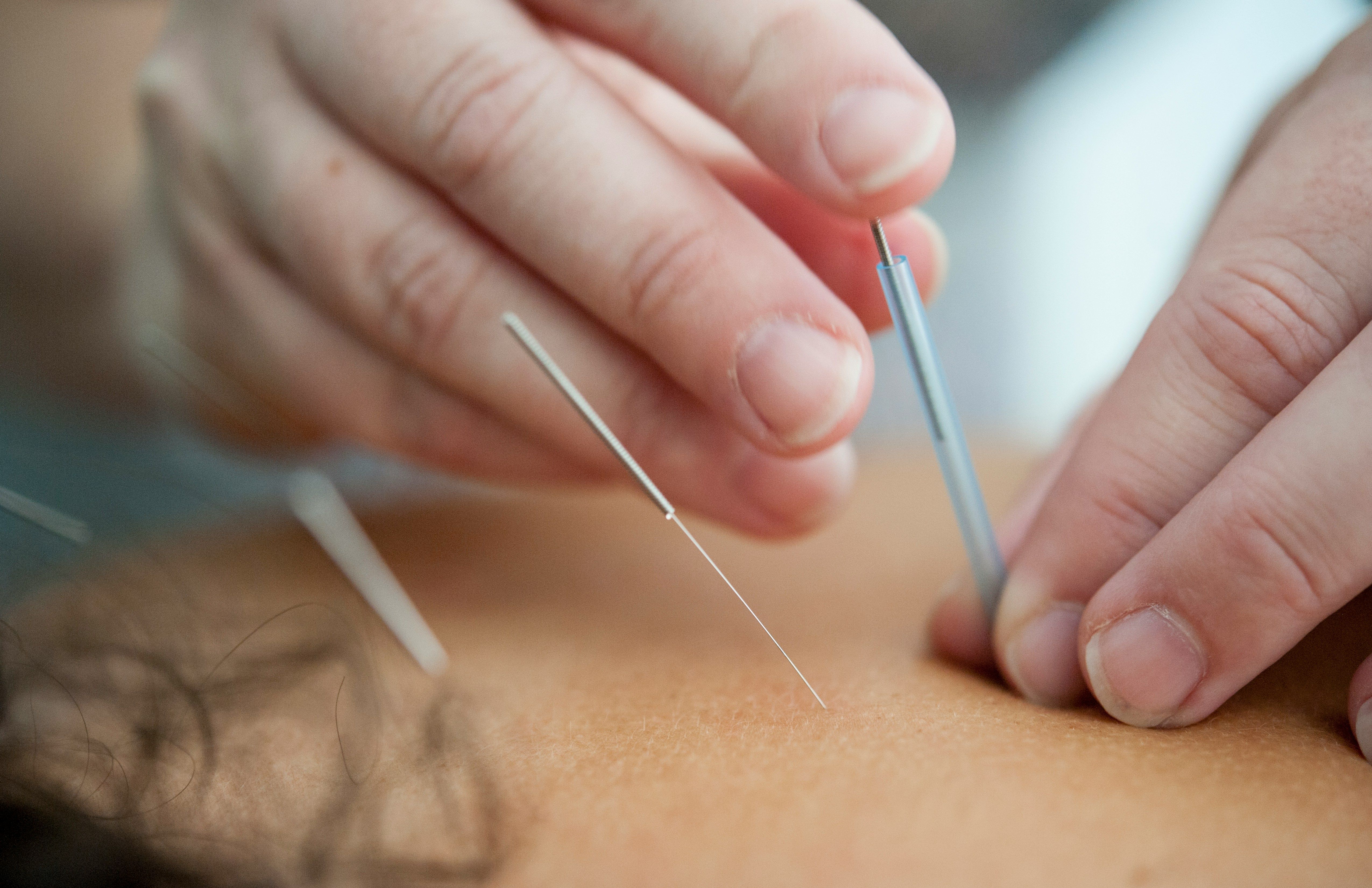 Symbolbild für Akupunktur